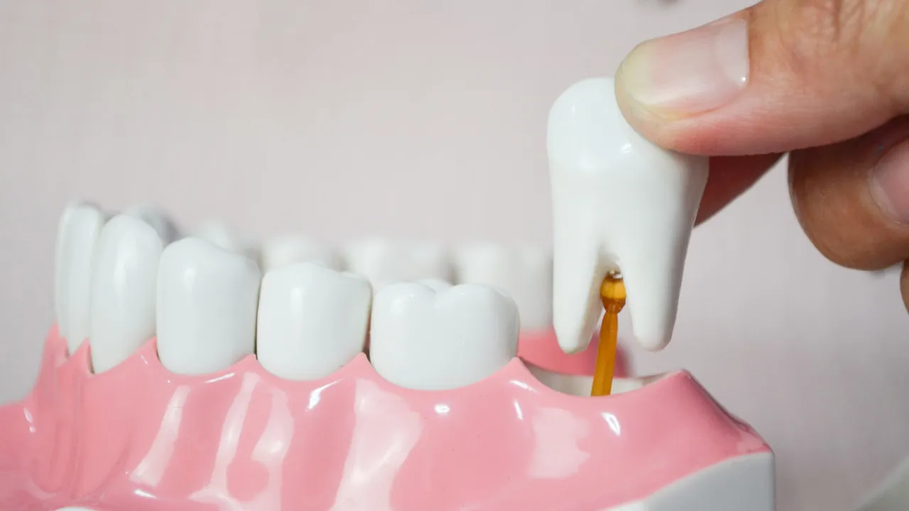 Células dos dentes do siso podem ajudar no tratamento de doenças graves