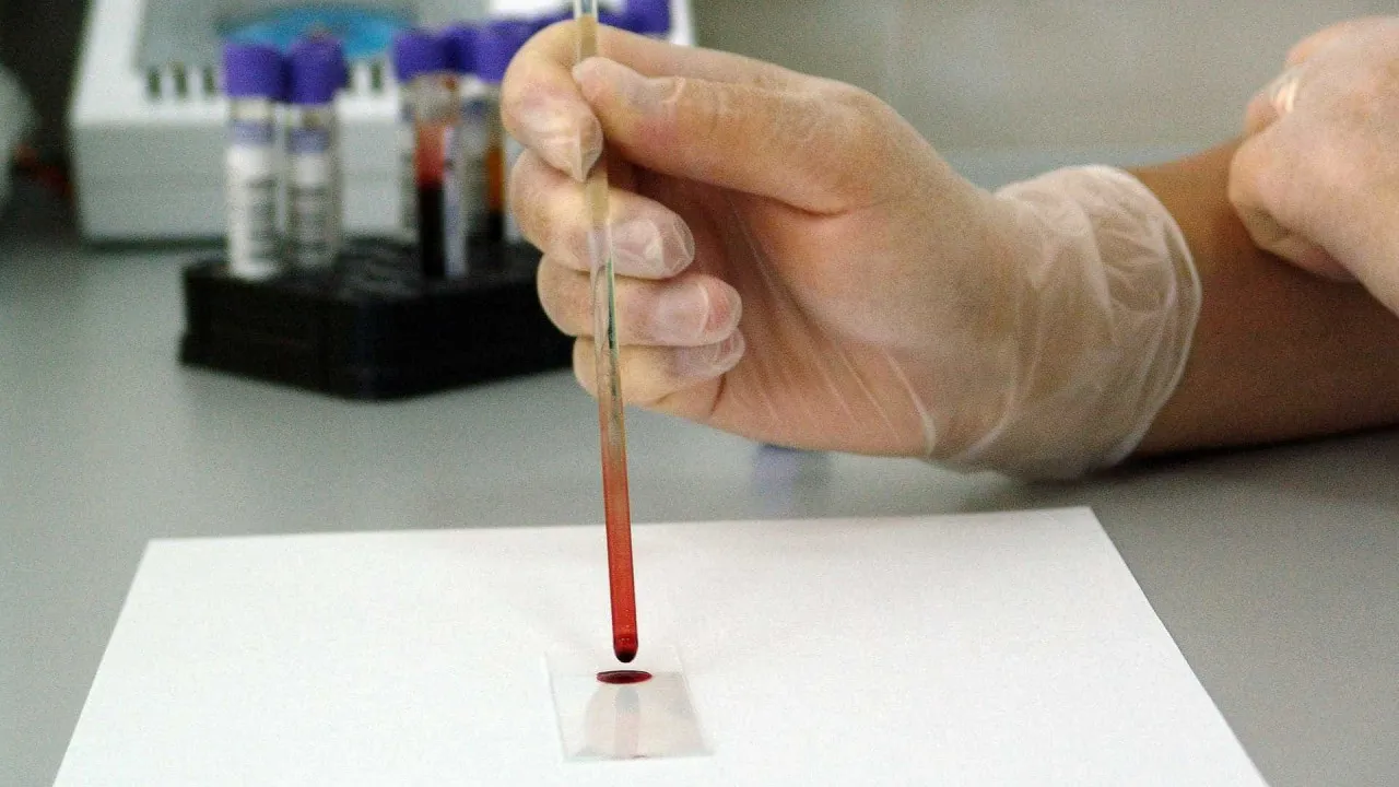 Leucemia? Teste de sangue poderá substituir amostras de medula na deteção